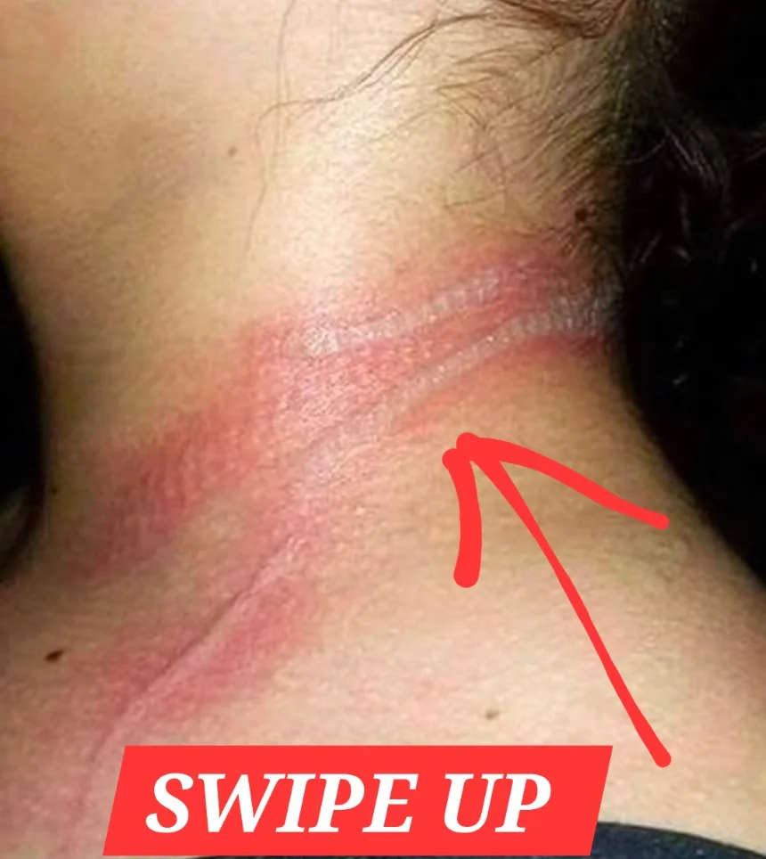 13-year-old girl left with horrific burns on her neck after using her cellphone while it was charging - DAILY DAILYS